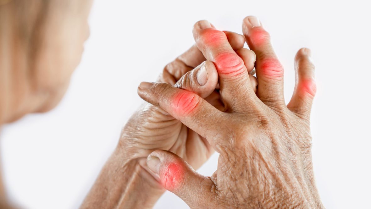 asian woman hand suffering from joint pain with gout in finger